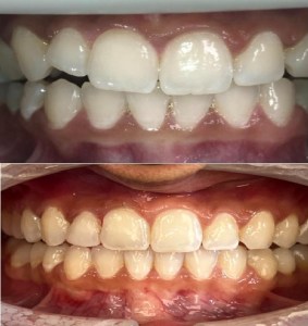 Invisalign before and afters