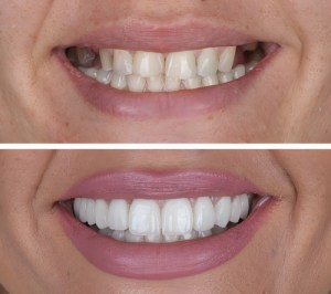 Before & After Teeth Whitening